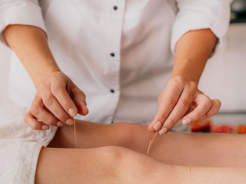 dry needling vs acupuncture