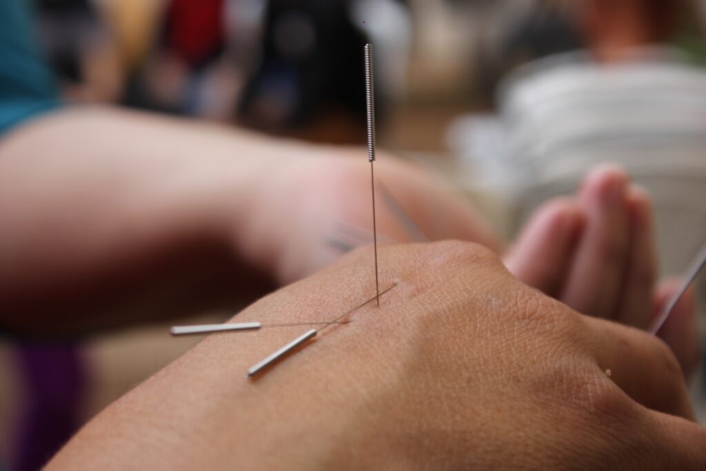 acupuncture process