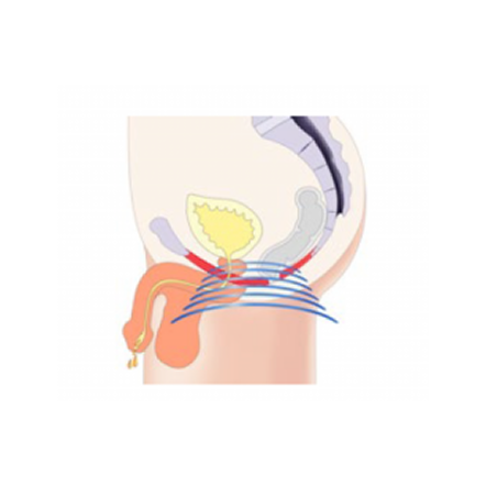 men emsella treatment
