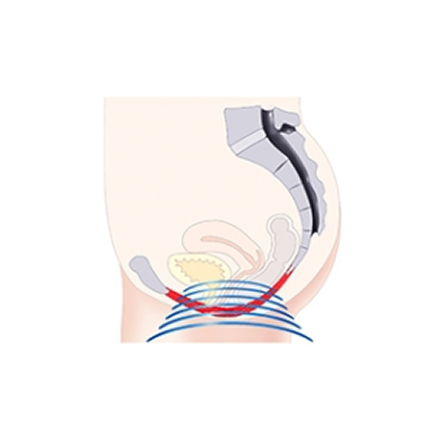 emsella treatment for women