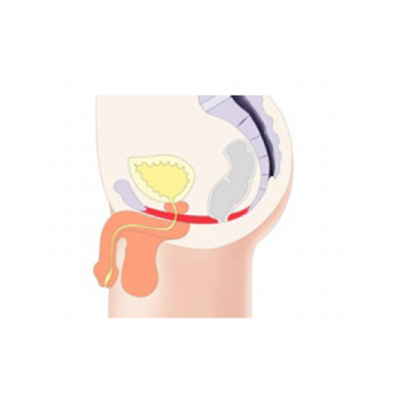 men after emsella treatment