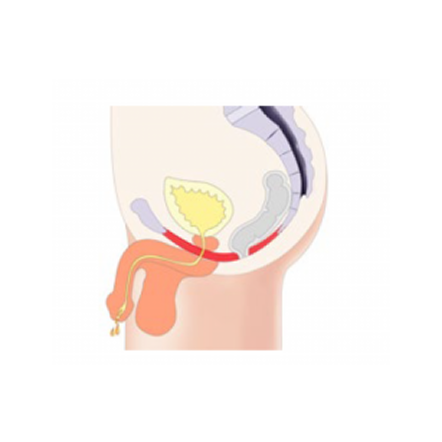 urinary incontinence in men