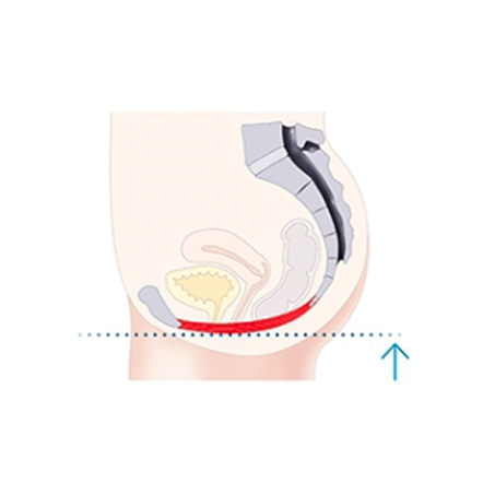 Pelvic muscles illustration after treatment