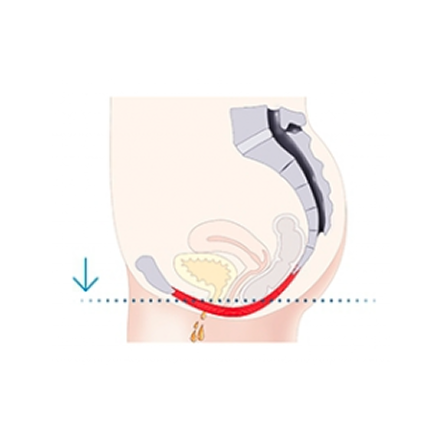 urinary incontinence in women